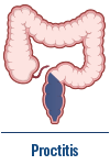 Proctitis