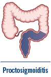 Proctosigmoiditis
